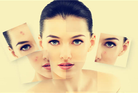 祛痘也要將就方法，不然后果很嚴(yán)重