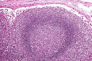 什么是前哨淋巴結(jié) 早期乳癌精確分期并發(fā)癥減少 什么是前哨淋巴結(jié) 早期乳癌精確分期并發(fā)癥減少