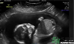 子宮內胎兒自打臉 揭秘胎兒子宮內生活.png