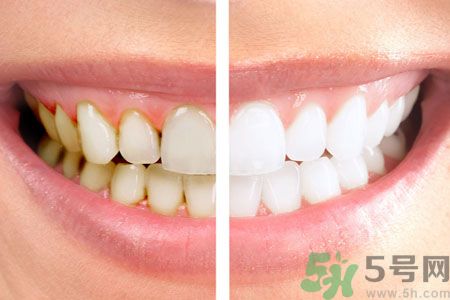 牙齒有黃斑怎么辦？牙齒有黃斑怎么去除？