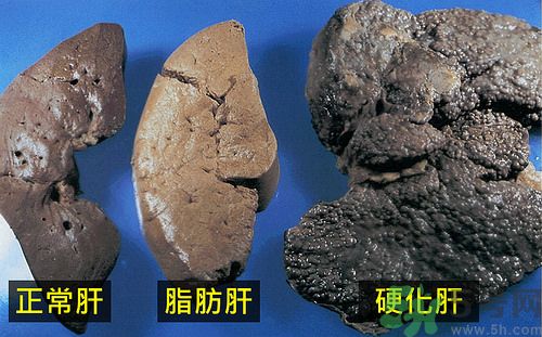 得了脂肪肝該怎么治？脂肪肝對人體危害有多大？