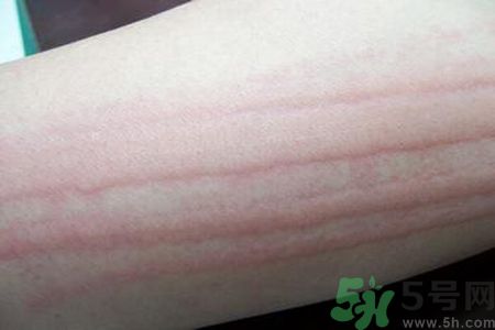 蕁麻疹會不會傳染？蕁麻疹怎么治才能好？