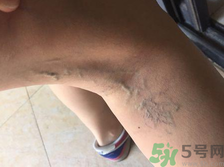 40歲女性小腿靜脈曲張?jiān)趺崔k？