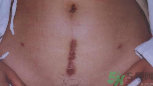 剖腹產疤痕怎么修復?剖腹產如何護理不留疤痕?.jpg