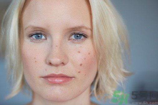 為什么會(huì)長痘痘？痘痘有哪幾種類型的？