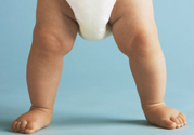 孩子一個(gè)腿長(zhǎng)一個(gè)腿短是什么??？孩子長(zhǎng)短腿怎么辦？