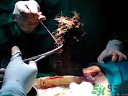 女孩偷吃頭發(fā)5年 吃頭發(fā)是什么病?.png 女孩偷吃頭發(fā)5年 吃頭發(fā)是什么病?.png