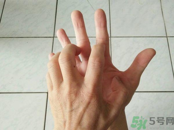 手上起水泡是什么原因？怎樣預防手上起水泡？