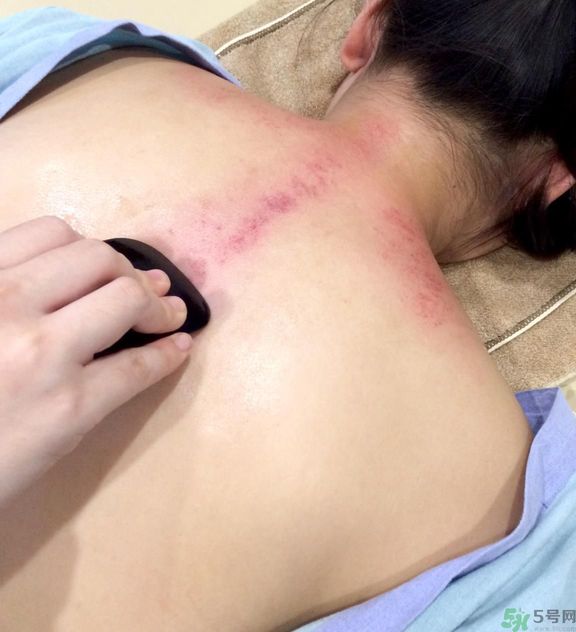 刮痧的好處有那些？夏季刮痧要注意什么？