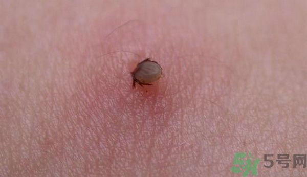 蜱蟲(chóng)叮咬后有什么癥狀?蜱蟲(chóng)叮咬后怎么處理