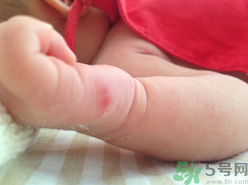 被蚊子咬了起紅點(diǎn)怎么消除?被蚊子咬會得什么病