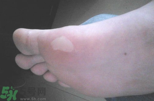 夏天腳脫皮起泡是怎么回事?夏天腳脫皮起泡怎么辦? 夏天腳脫皮起泡是怎么回事?夏天腳脫皮起泡怎么辦?