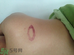 種草莓吻痕是什么意思？吻痕是怎么弄出來的？