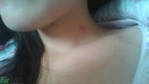 種草莓吻痕是什么意思？吻痕是怎么弄出來的？