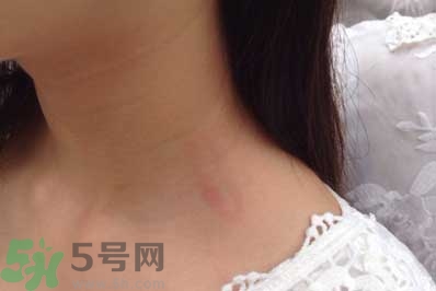 種草莓吻痕是什么意思？吻痕是怎么弄出來的？