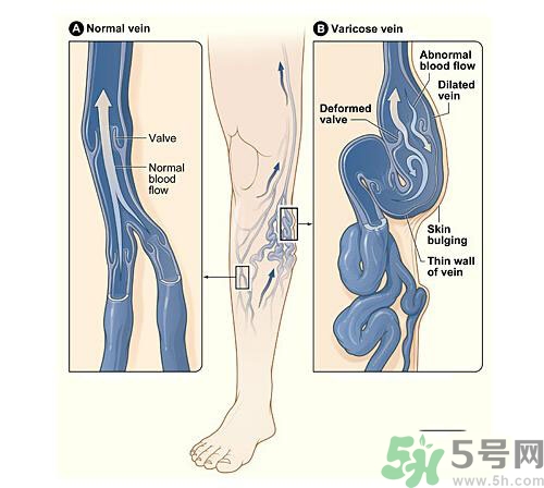 什么樣的人容易得筋脈曲張？靜脈曲張的原因