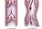 什么樣的人容易得筋脈曲張？靜脈曲張的原因