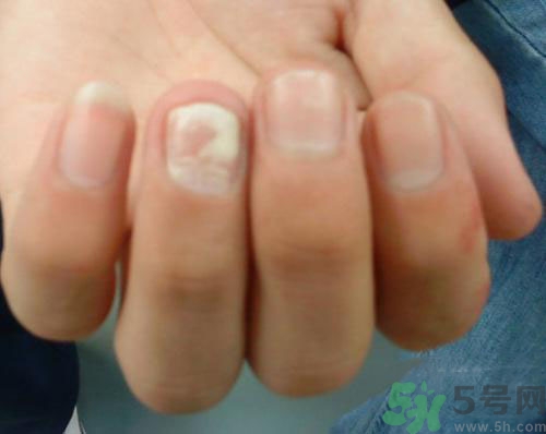 指甲發(fā)白是怎么回事？指甲發(fā)白代表什么？