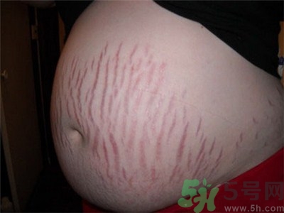 生完孩子后肚子上的黑線(xiàn)怎么辦?生完孩子后肚子上的黑線(xiàn)多久消失