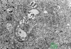 裂谷熱病怎么治？裂谷熱病的癥狀有哪些？