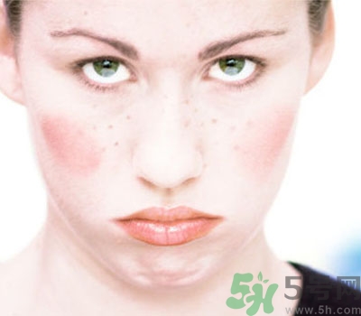 夏季流汗臉癢怎么回事？夏季臉癢怎么辦？