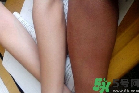 腿曬黑了怎么白回來？腿曬黑了怎么辦？