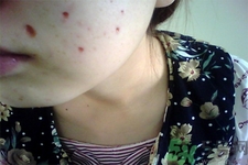 激光點痣后可以洗臉嗎？激光點痣后需要注意什么？