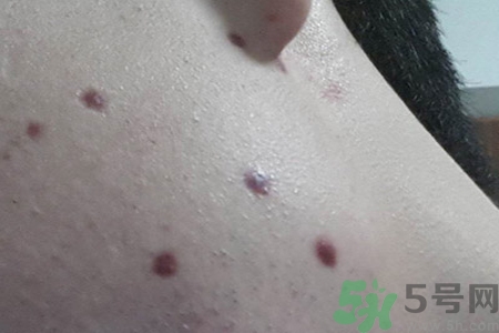 激光點痣后可以洗臉嗎？激光點痣后需要注意什么？