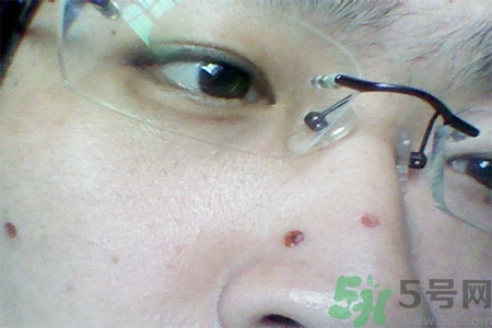 激光點(diǎn)痣后可以洗臉嗎？激光點(diǎn)痣后需要注意什么？