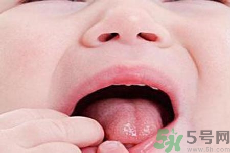 寶寶口腔潰瘍?cè)趺崔k？治療寶寶口腔潰瘍方法有什么？