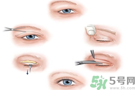 割雙眼皮分哪幾種？割雙眼皮需要多少錢？