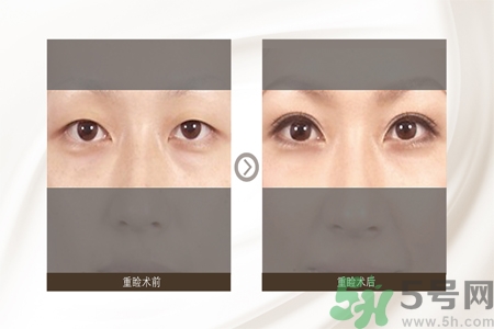 割雙眼皮分哪幾種？割雙眼皮需要多少錢？