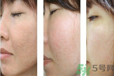 皮膚毛孔粗大原因有哪些？如何預(yù)防皮膚毛孔粗大？