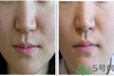 皮膚毛孔粗大原因有哪些？如何預(yù)防皮膚毛孔粗大？