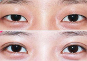 割雙眼皮分哪幾種？割雙眼皮需要多少錢？