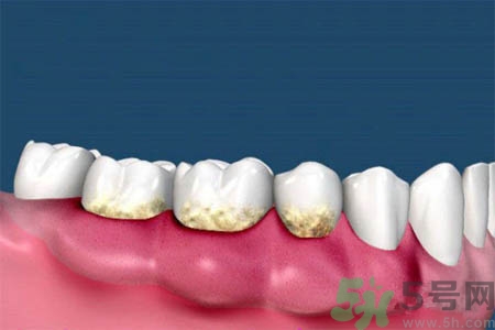 哪些人不能洗牙？洗牙需要注意什么？