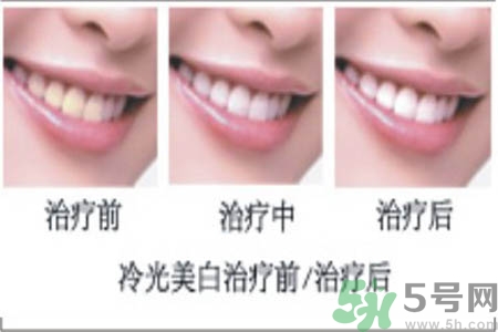 冷光美白牙齒是什么？冷光美白牙齒的好處有哪些？