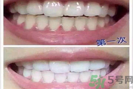 冷光美白牙齒的價(jià)格是多少？做冷光美白牙齒需要多少錢(qián)？