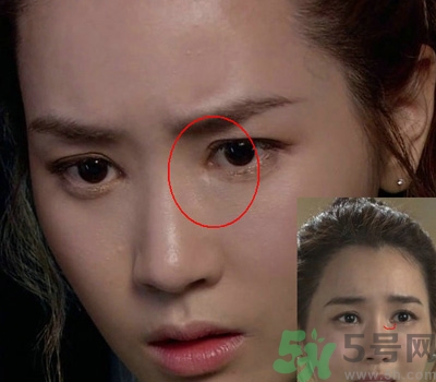 開眼角多少錢？開眼角有什么危害？