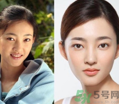 開眼角眼睛會(huì)變大嗎？開眼角眼睛能大多少？