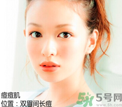 眉心長痘痘是什么原因？眉心長痘痘怎么辦？