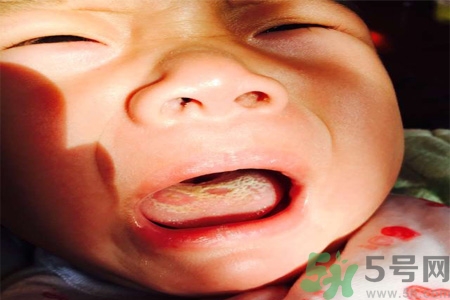 舌頭燙傷后該怎么辦呢？舌頭燙傷后應(yīng)該注意吃什么？?