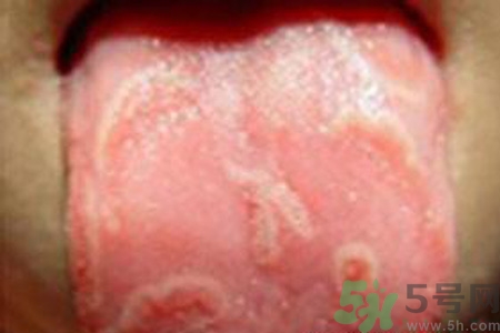 舌頭燙傷后該怎么辦呢？舌頭燙傷后應(yīng)該注意吃什么？?