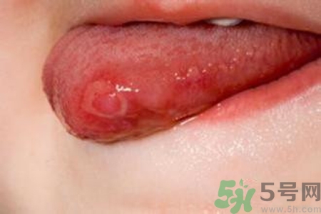 舌頭長泡怎么辦？舌頭長泡的原因？