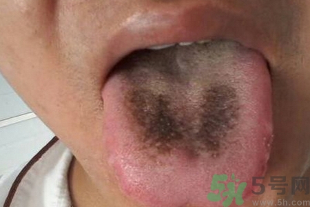 舌頭發(fā)黑怎么回事？舌頭發(fā)黑怎么辦？