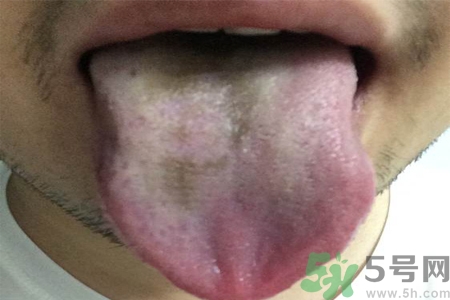 舌頭發(fā)黑怎么回事？舌頭發(fā)黑怎么辦？
