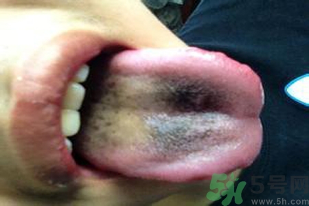 舌頭發(fā)黑怎么回事？舌頭發(fā)黑怎么辦？