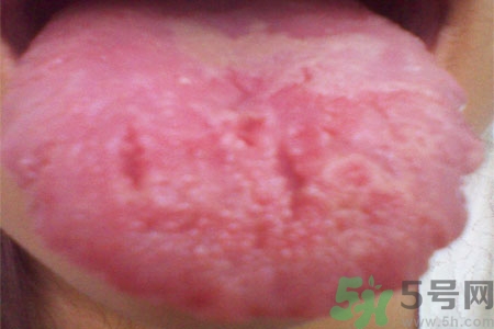 舌頭上有裂紋是怎么辦？舌頭上有裂紋是什么原因？