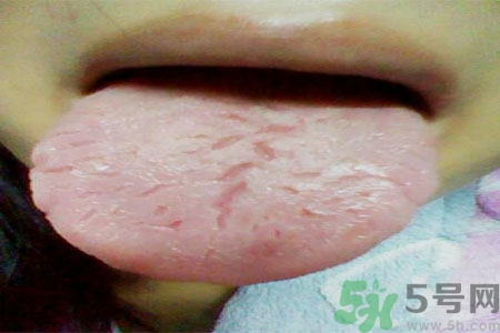 舌頭上有裂紋是怎么辦？舌頭上有裂紋是什么原因？