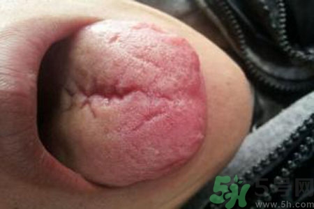 舌頭上有裂紋是怎么辦？舌頭上有裂紋是什么原因？